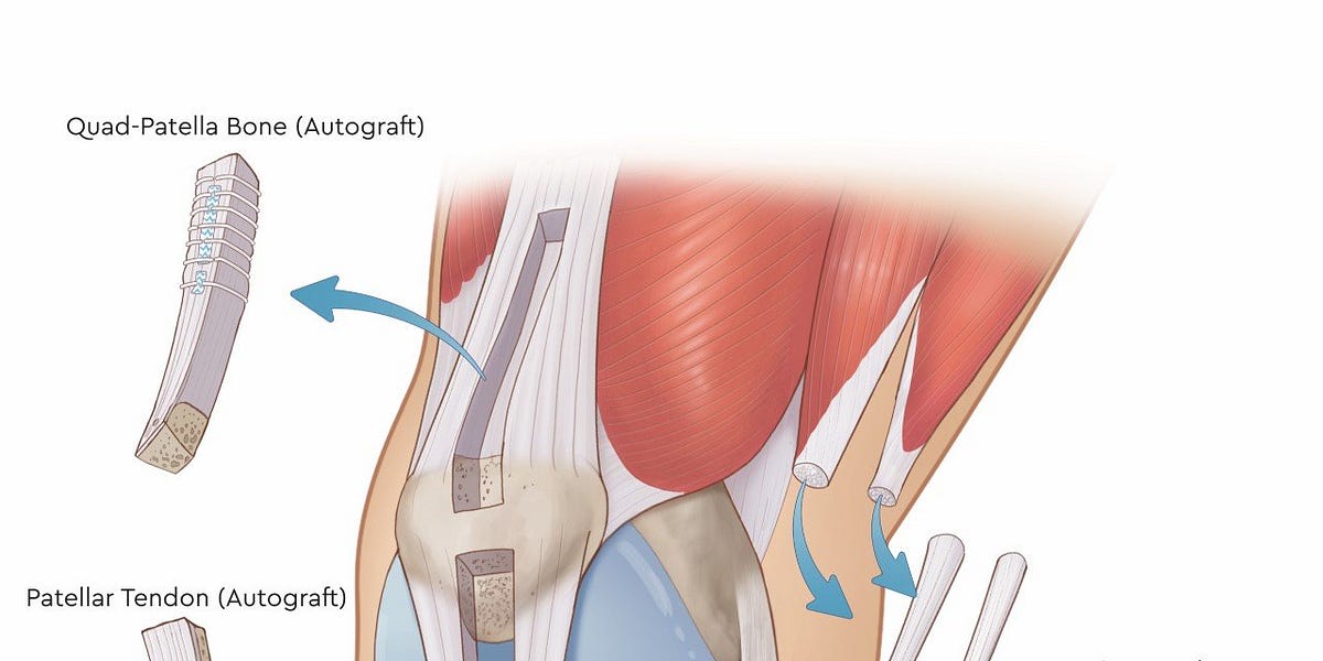 Anterior Cruciate Ligament (ACL) Reconstruction - Patellar Tendon ...
