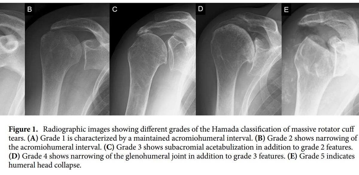 Rotator cuff arthropathy deals