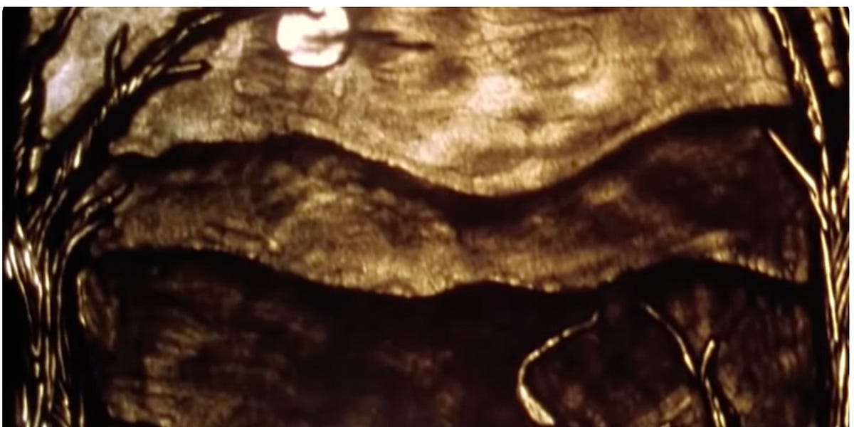 "What is Disease X?"