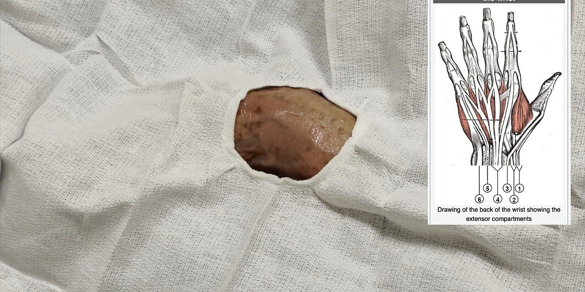 Wrist Arthrocentesis Dorsal Compartment IV Approach