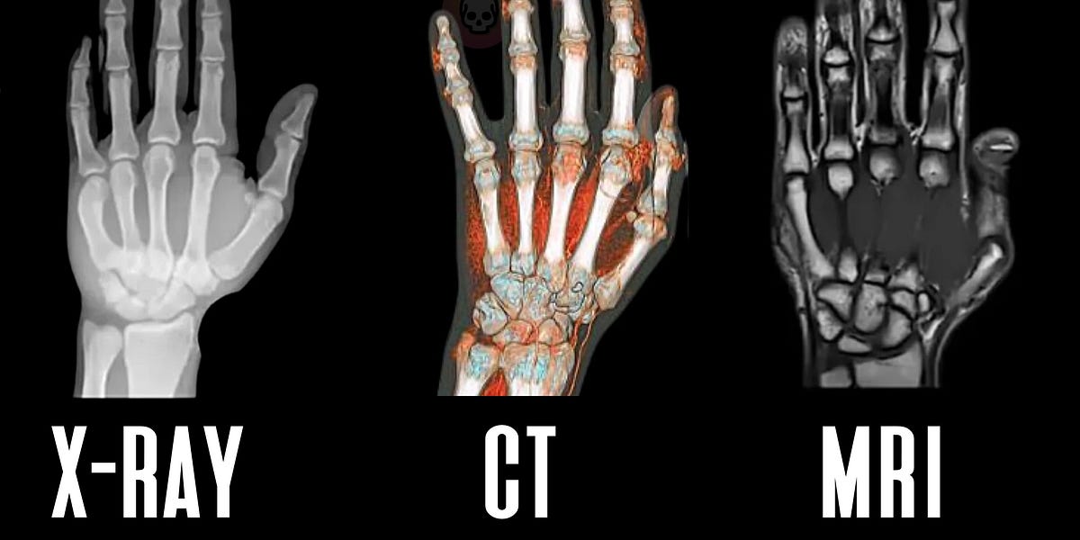 Comparison of X-ray, CT, and MRI Imaging of a Hand
