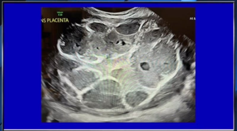 EXPECTING MOMS: Proof C19 Vaxes Aren't Safe