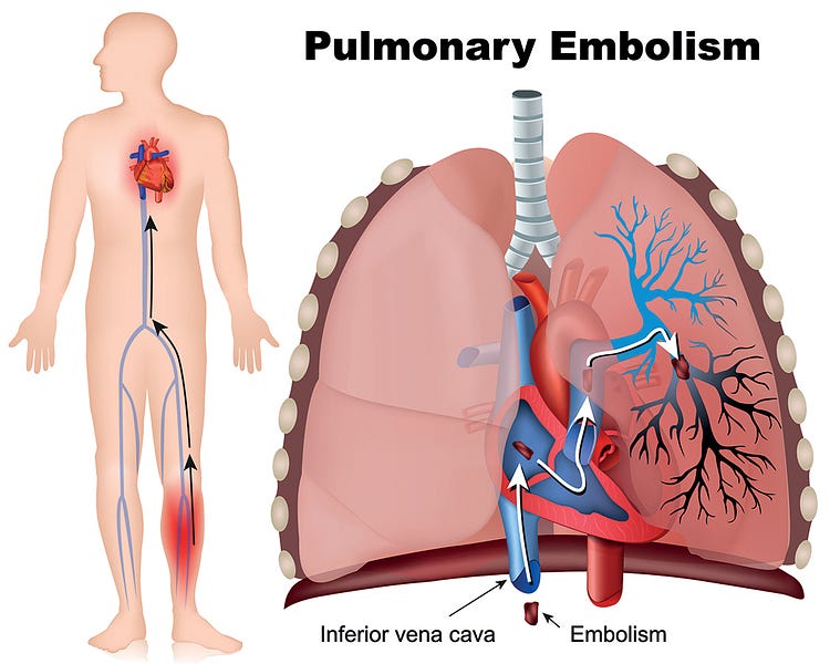 FDA acknowledges that pulmonary embolism generated a safety signal