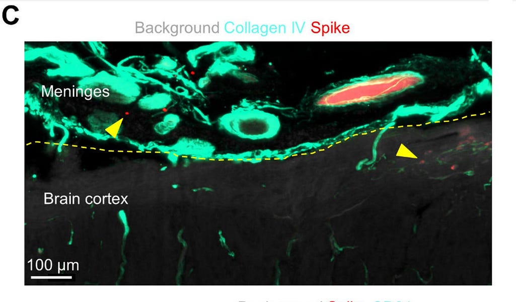 Spike protein accumulates in the brain and causes infarcts, bleeds, inflammation - Pfizer & Moderna COVID-19 mRNA vaccines cause severe neurological injuries