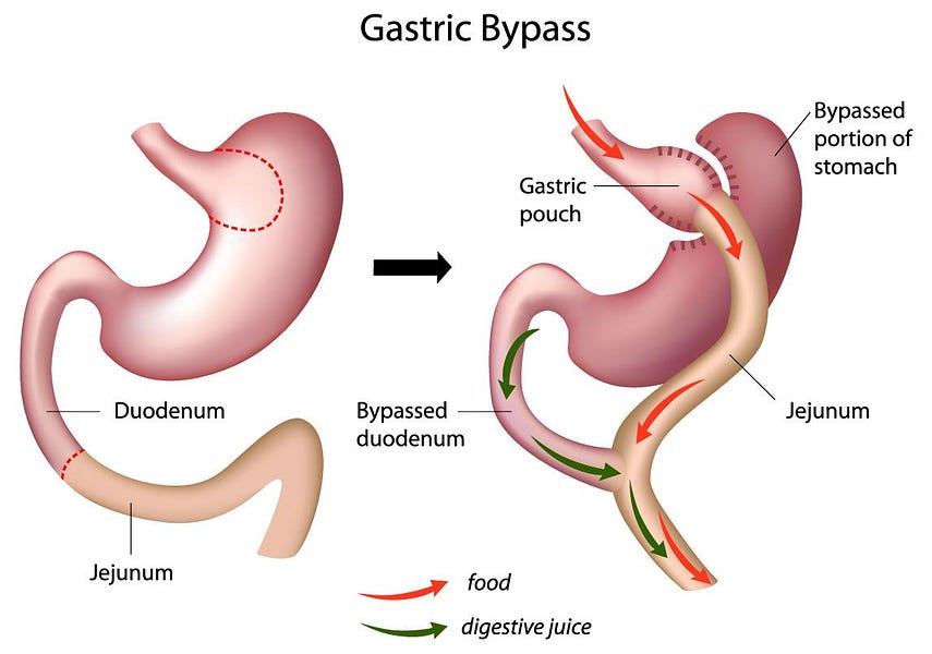 Bariatric Surgery Gastric Bypass vs. The Sleeve
