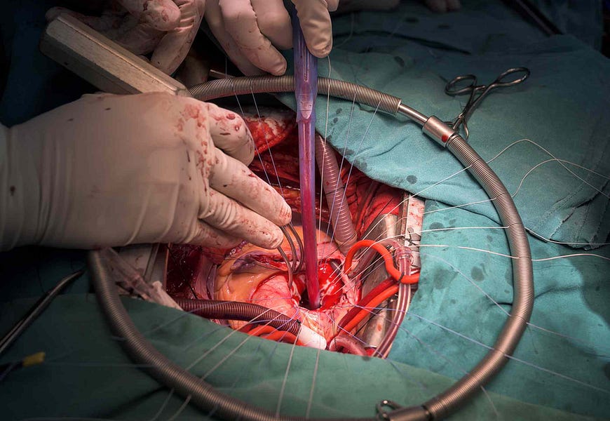 How Does A Heart Surgeon Prevent A Heart Attack