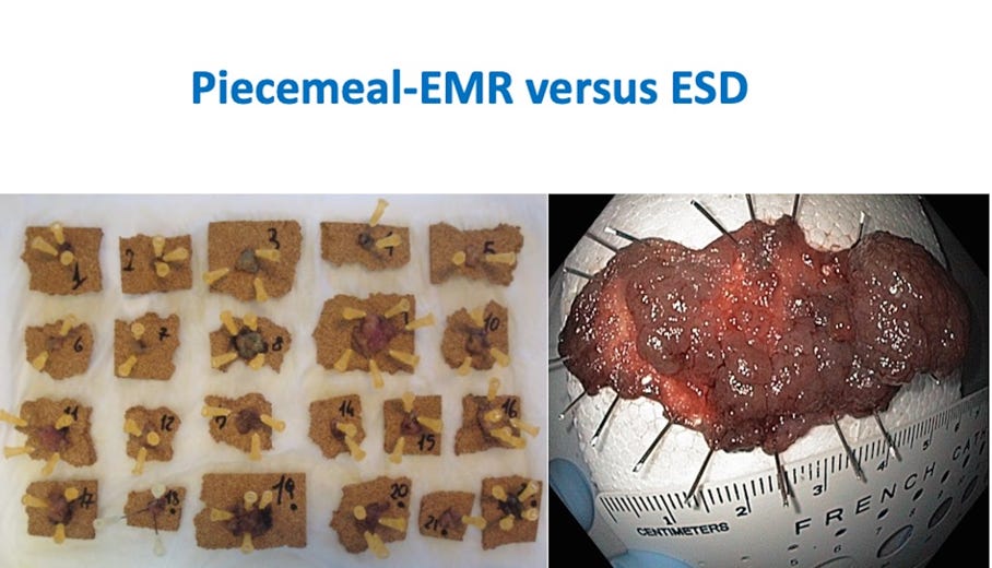 Is Endoscopic Submucosal Dissection (ESD) Ready to Enter CenterStage