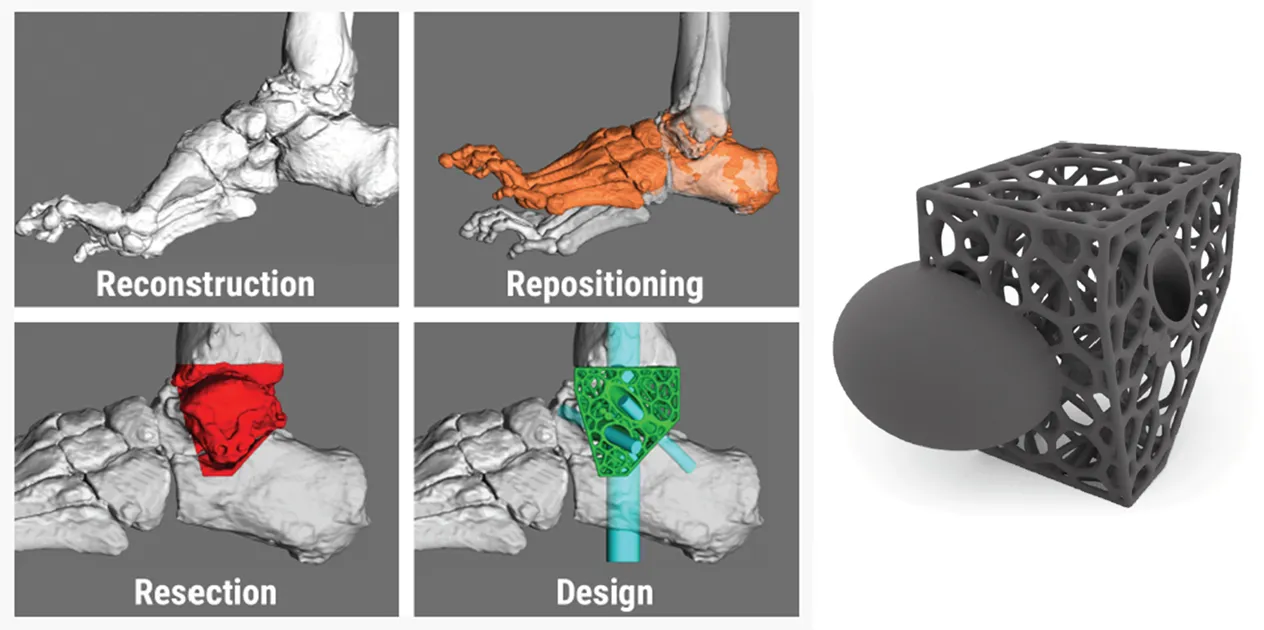 3D Printed Titanium Truss - Talar Bone Loss Specific Implant