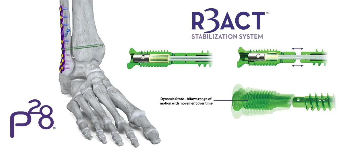 R3ACT Syndesmotic System - for Ankle Syndesmosis Injuries