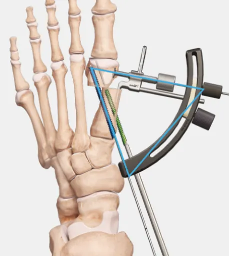 Arthrex MIS Bunionectomy Set - for Hallux Valgus Correction
