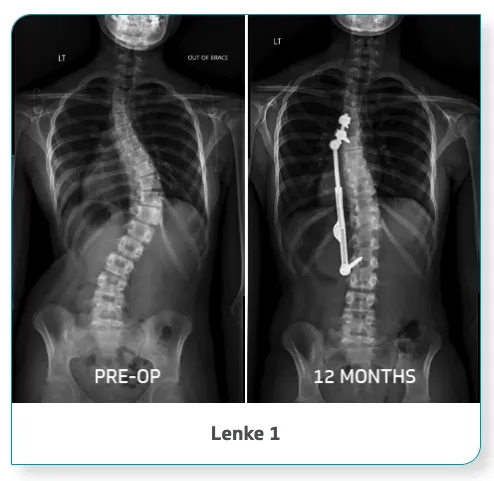 APiFix® - Scoliosis Correction System