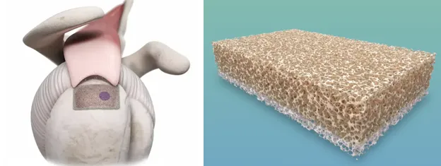 BioEnthesis - Rotator Cuff Repair Augmentation