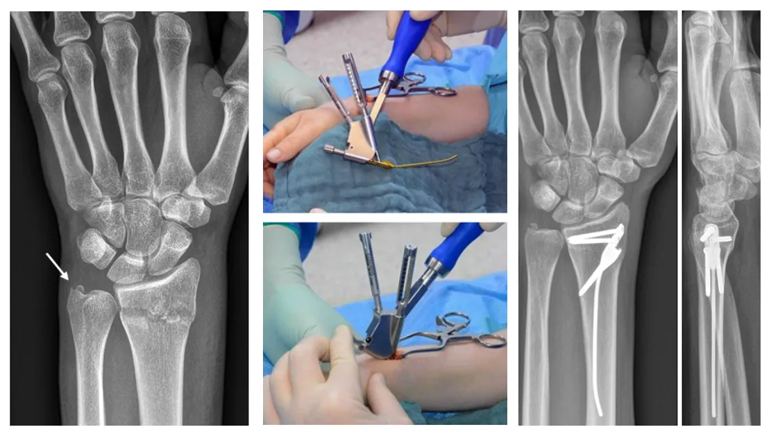 DRIM-NAIL - Distal Radius IntraMedullary Nail