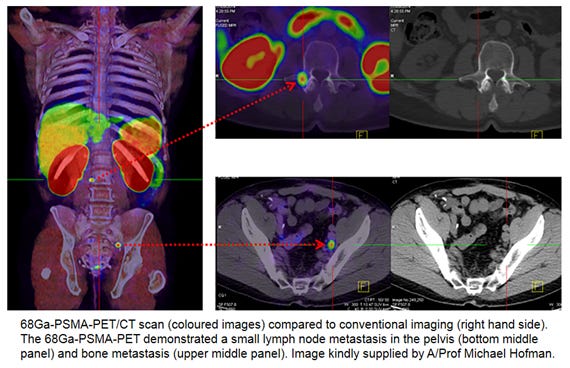 Is PSMA-PET imaging in the cards for Low-Risk Active Surveillors? 