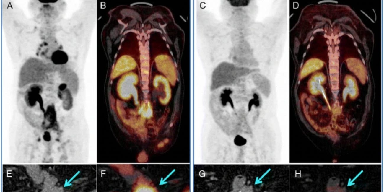 IgG4-related disease (IgG4RD) means FIBROSIS and organ destruction