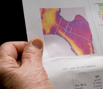 The great osteoporosis scam