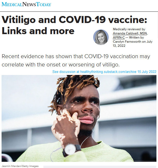 CLINICAL RESEARCH: Autoimmune disease VITILIGO reported in several "assumed to be rare" cases following Cv19 vaccination