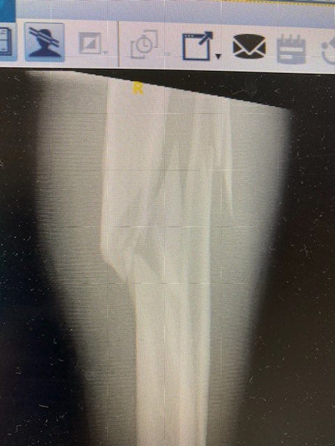 Here’s How My Ski Season Ended