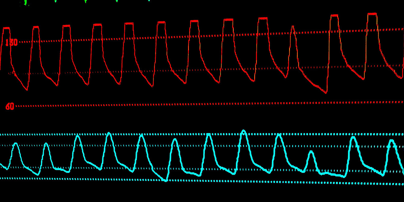 Beta-blockers for septic shock (STRESS-L trial)