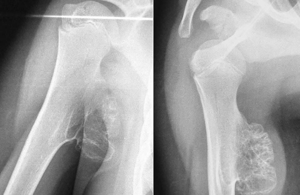Case 36: A Humeral Projection