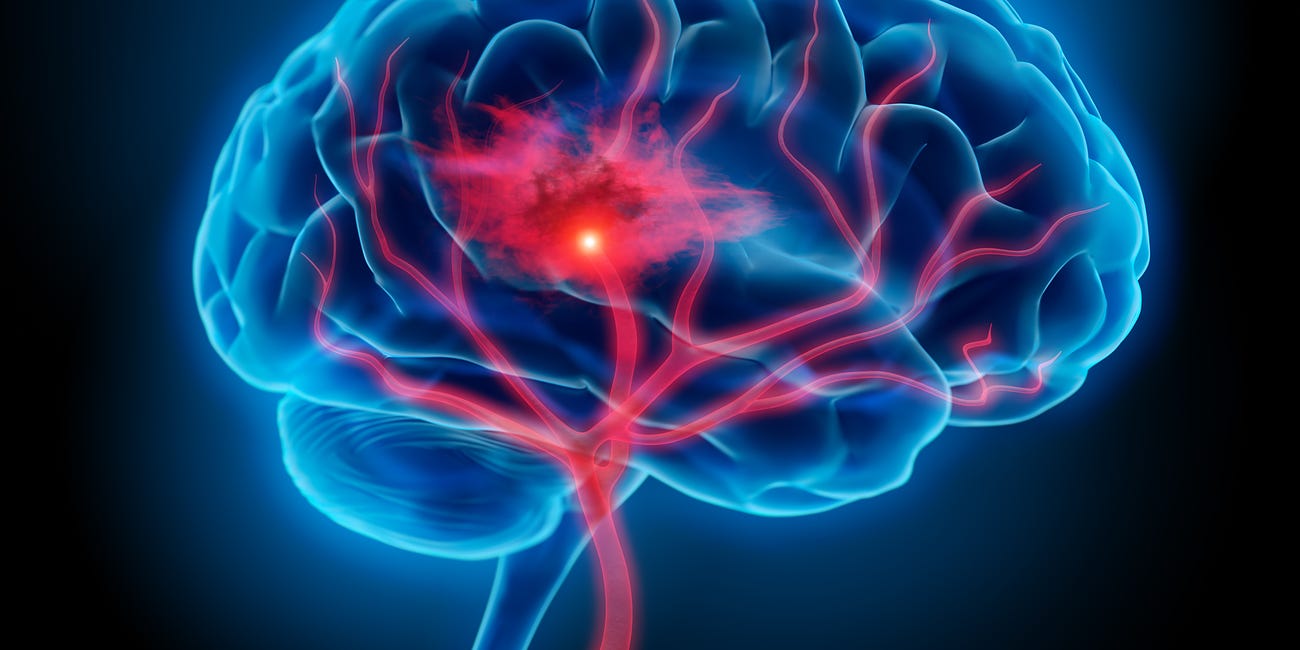 Tenecteplase for acute ischemic stroke presenting after 4.5 hours (TIMELESS trial)