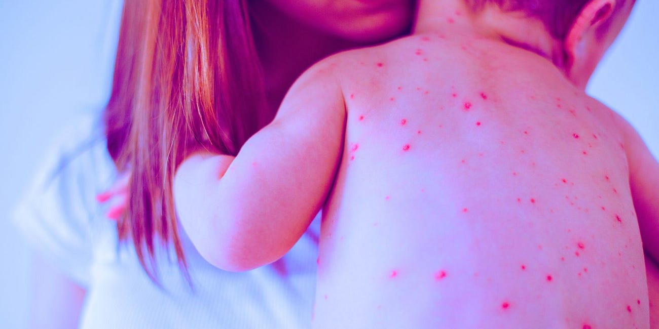 Texas Gave 15,000 More MMR Shots This Year—Now It Has More Measles Cases Than the Entire U.S. Had in 2024