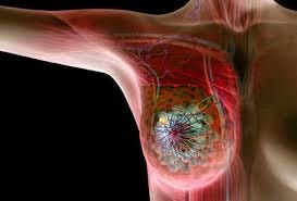 On the futility of breast cancer screening