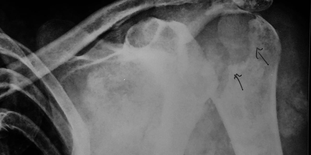 Case 45: Shoulder in Ruin