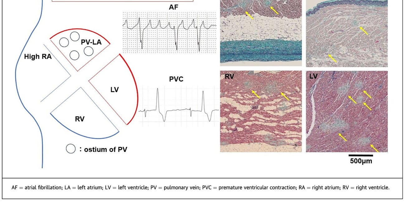 NEW AUTOPSY STUDY - Cardiac Micro-Scars in Sudden Death Following COVID-19 Vaccination