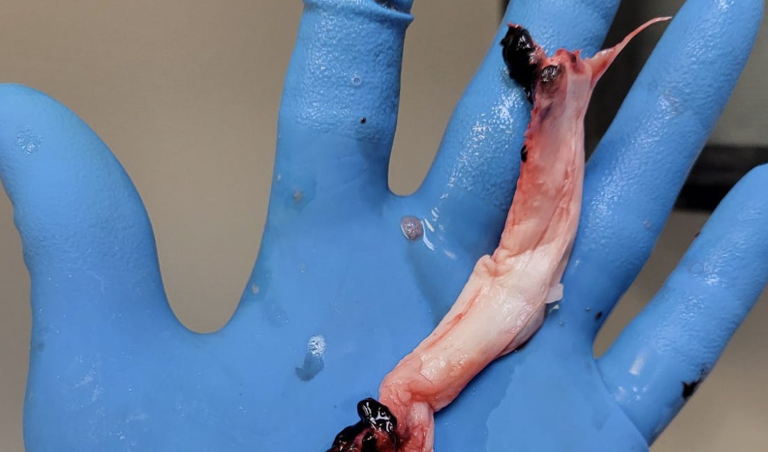 Notes from Twitter Space on Blood Clots