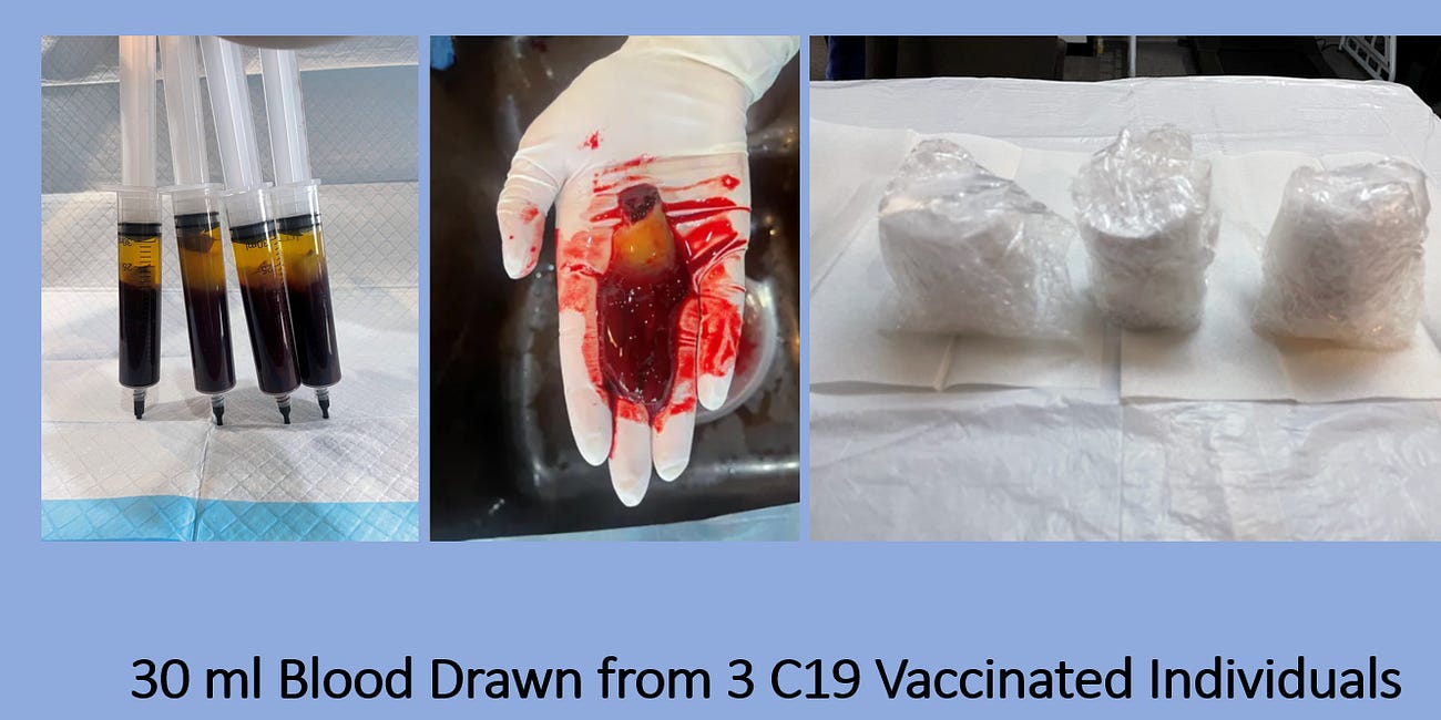 Comparison Microscopic Analysis Of Three C19 Vaccinated Blood Clots Shows No Difference Between Vaccine Injured And Asymptomatic - Nanotech Synthetic Biology Filaments Seen