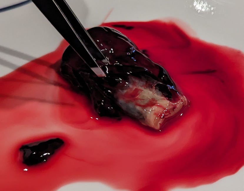 Rubbery Clot Development In C19 Unvaccinated Individual With Previous Deep Vein Thrombosis and Massive Pulmonary Emboli - While On Eliquis, Nattokinase, Lumbrokinase and Serreptase