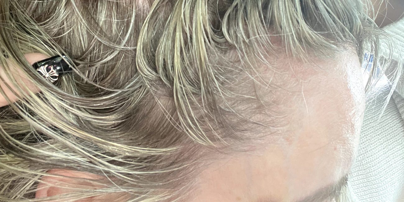 Botox Bruise Divorce Bombshell: NJ Mom Accused of False Abuse, Fraud
