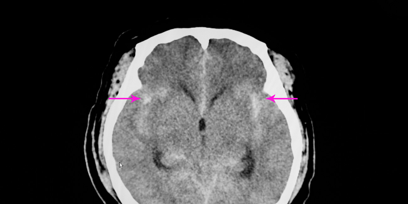 Blood transfusion targets in acute brain injury: Review (Updated)