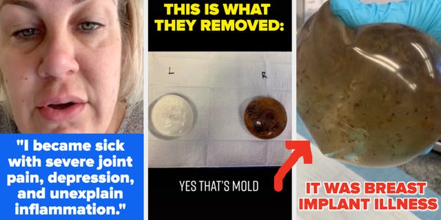 Mold, Pneumonia, and the Underwire: A Troubling Trio