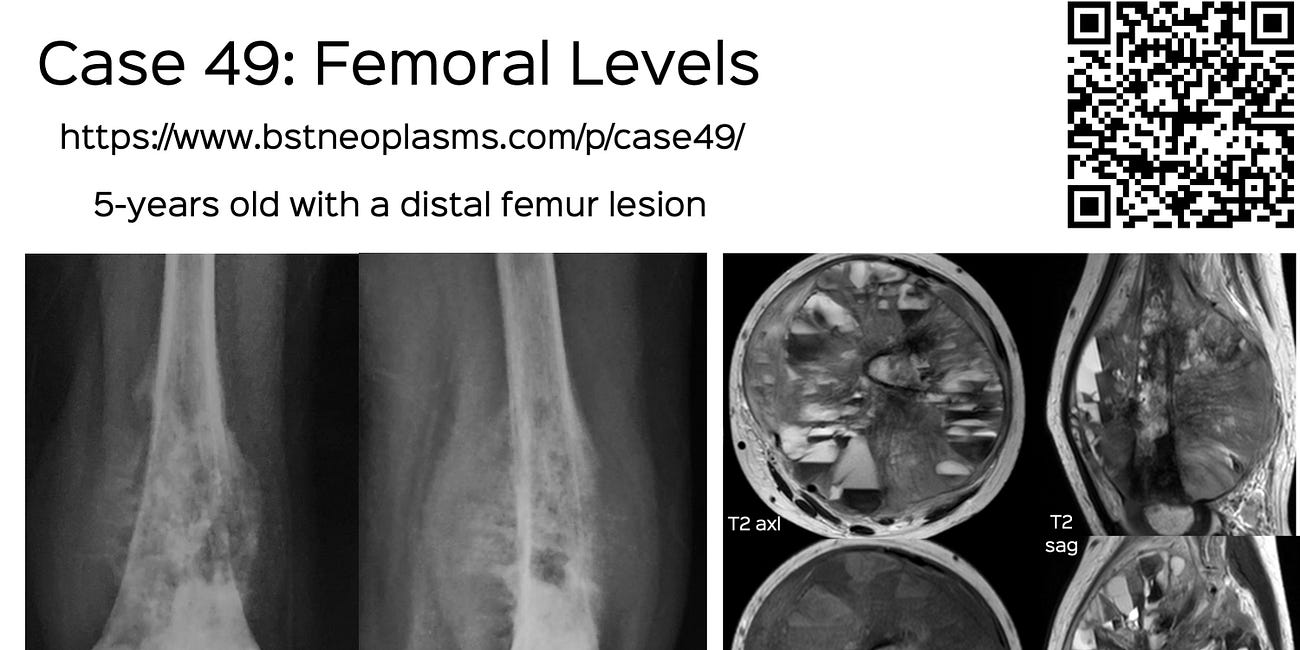 Case 49: Femoral Levels