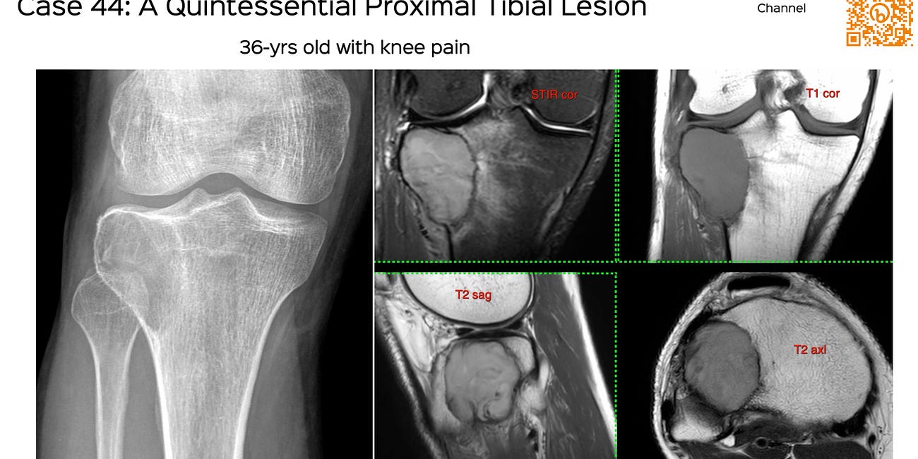 Case 44: A Quintessential Proximal Tibial Lesion