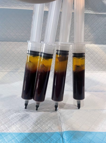 Inspection visuelle des caillots sanguins vivants vaccinés contre le C19 - Substance semblable à du caoutchouc (hydrogel) détectée - Méfiez-vous des images graphiques