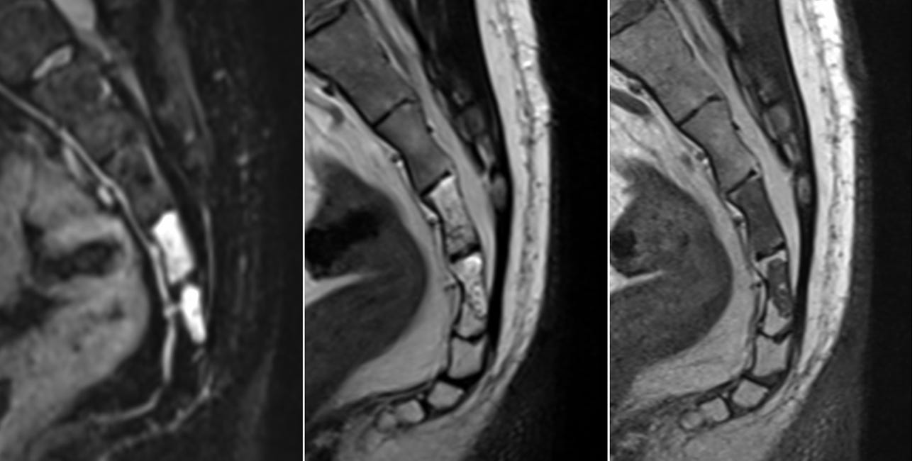 Case 41: Sacral Signals