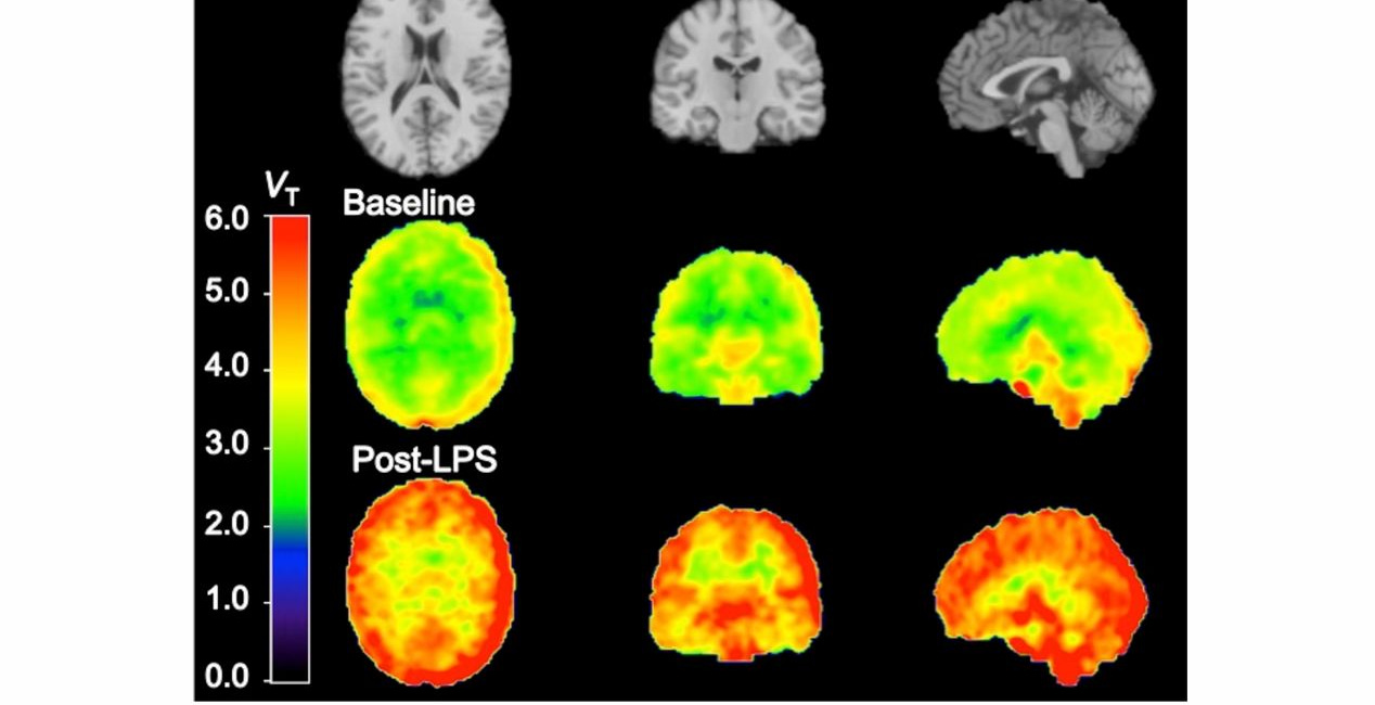 Fatigue, Headache, Muscle Pain, Fever and Chills after Pfizer Jabs match Endotoxin Effects