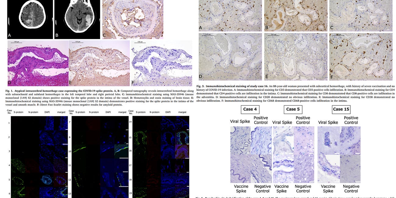 BREAKING STUDY — COVID-19 mRNA Injection Spike Protein Expressed in Cerebral Arteries of Stroke Patients for Up to 17 Months