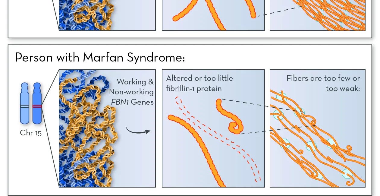 Marfan Syndrome