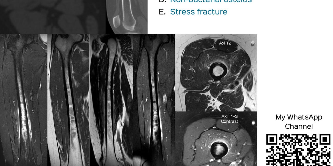 Case 51: Long Femur Disease