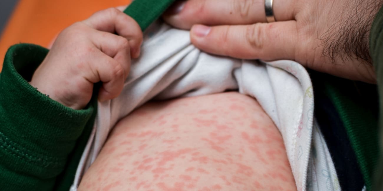 Measles is NEVER (ever!) Beneficial