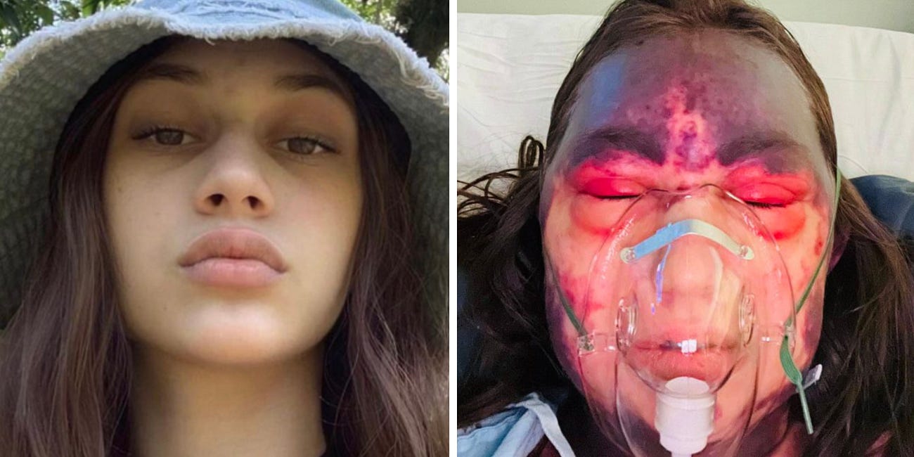 Horrific Vaccine Injury Leaves 23-Year-Old Woman Fighting for Her Life