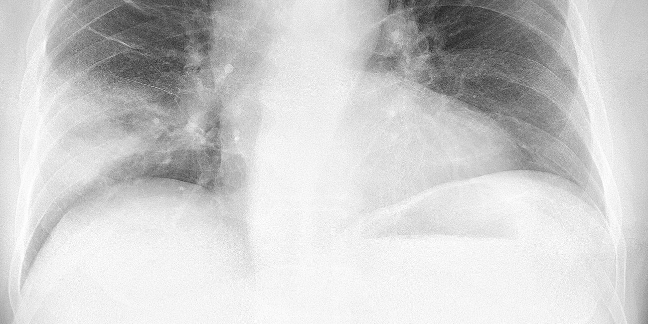 Medical Hypothesis: Respiratory epidemics and pandemics without viral transmission