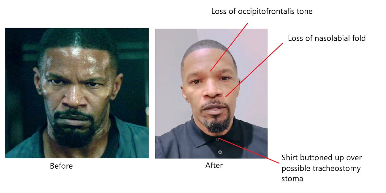 Jamie FOXX: his recent appearance raises more questions than answers & point to a devastating COVID-19 vaccine induced stroke; FOXX's family & doctor & he must come clean & inform the world about the 