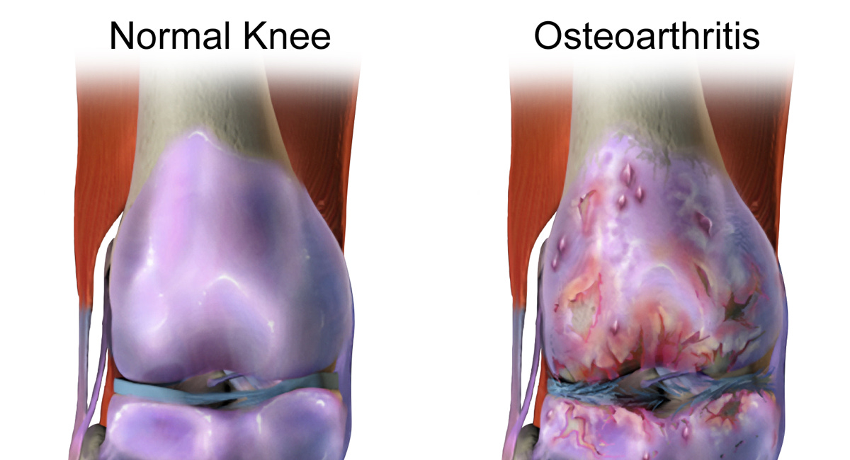 Osteoarthritis: Curse of old age or plague of modernity?