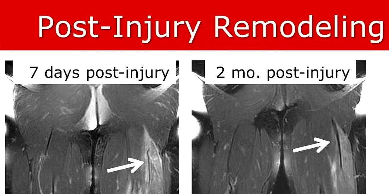 Hamstring Injuries: Understanding the Internal Ecology of Injury 