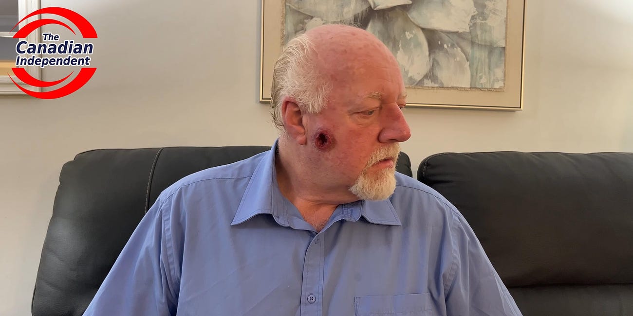 EXCLUSIVE: Ontario Man with a Massive Gaping Hole on the Side of His Face Struggles to Obtain Prompt Healthcare in the Province.